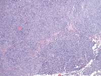 Low magnification of Sertoli-Leydig cell tumor of...