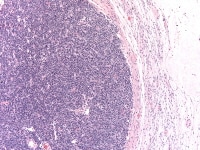 Poorly differentiated Sertoli-Leydig cell tumor s...