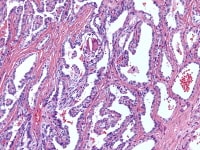 Retiform Sertoli-Leydig cell tumor shows admixtur...