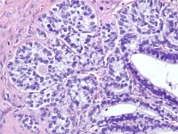 Gynandroblastoma shows granulosa cell with well-f...