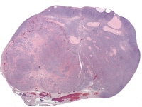 Leydig cell tumor (H&E, x5).