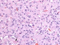 Higher magnification of Leydig cell tumor shows L...