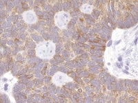 Granulosa cell tumor, microfollicular pattern sho...