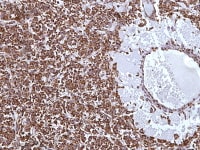 Juvenile granulosa cell tumor demonstrating stron...