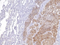 Metastatic ovarian granulosa cell tumor to the lu...