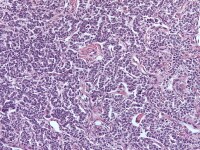 Granulosa cell tumor, gyriform pattern (H&E, ...