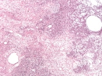 Juvenile granulosa cell tumor. Follicles of varyi...