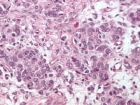 Juvenile granulosa cell tumor. The cells have abu...