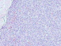 Metastatic breast carcinoma shows diffuse infiltr...