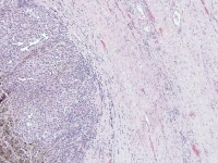 A case of metastatic melanoma to the ovary shows ...