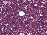 Small cell carcinoma, hypercalcemic type shows di...