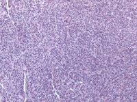 Granulosa cell tumor, diffuse pattern (H&...