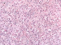 Steroid cell tumor shows steroid cells with abund...