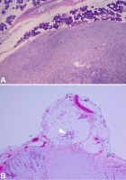 Capsule in pleomorphic adenoma. Image A shows a p...