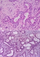Cells in pleomorphic adenoma. Image A shows tubul...
