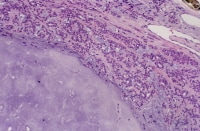 Cellularity in pleomorphic adenoma. This image sh...