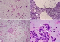 Unusual findings in pleomorphic adenoma. (A) Tyros