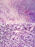 Undifferentiated carcinoma ex pleomorphic adenoma.