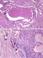 Salivary duct carcinoma ex pleomorphic adenoma. Im