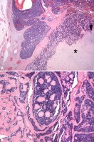 Adenoid cystic carcinoma ex pleomorphic adenoma. I