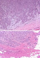 Myoepithelial carcinoma ex pleomorphic adenoma. Im