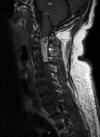 Ependymoma Ct