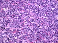 Granulocytic sarcoma (hematoxylin-eosin).
