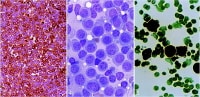 Monocytic sarcoma (left to right: lysozyme stain,...