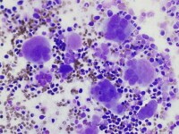 Megakaryocyte dysplasia: hyperlobate nuclei and m...