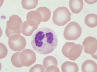 Pseudo–Pelger-Huet cell: neutrophil with bi...