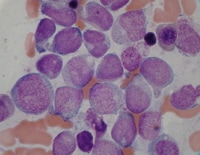 Acute myeloid leukemia from a patient who present...