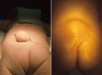 lipoma on buttock