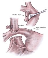 Bidirectional Glenn Anastomosis