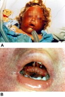 Traumatic Asphyxia Images