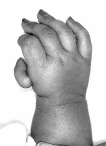  thumb of the right hand of a 6-month-old infant with Holt-Oram syndrome.