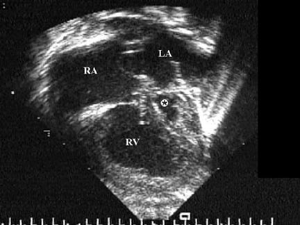 This echocardiographic still frame shows a 4-cham...