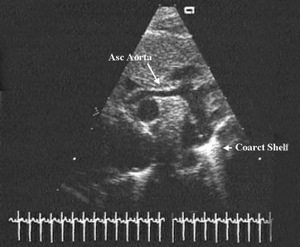 This echocardiographic still frame shows a long-a...