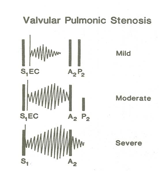 In valvar pulmonic stenosis, the severity of obst.
