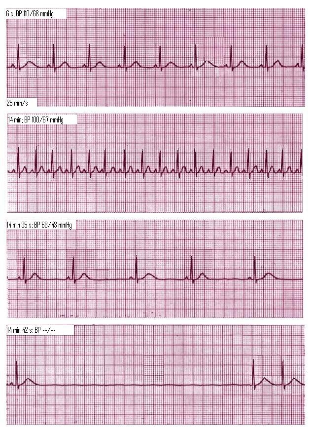 heart attack ecg. heart attack ecg. ECG rhythm strip of lead II