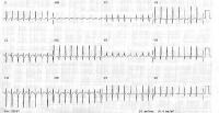 Preoperative electrocardiogram in a 2-month-old i...