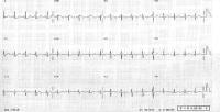 Electrocardiogram in 2-month-old infant with anom...