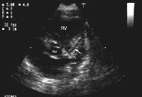Two-dimensional echocardiographic image (paraster...