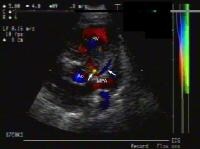 Two-dimensional echocardiographic image with colo...