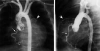 Aortogram in a patient with suspected anomalous o...