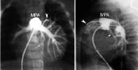 Main pulmonary artery angiogram demonstrating the...