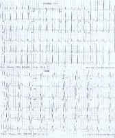 ECGs demonstrate a normal sinus rhythm and a sinus