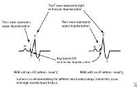 ECG depicts electrophysiologic events of right bun