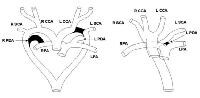 Right Aortic Arch In Vascular Ring Defects: Background, Pathophysiology 