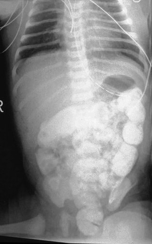 Neonatal Volvulus And Imperforate Anus Naked Photo