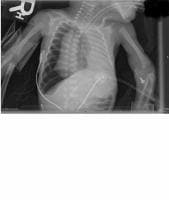 Neonate with a right tension pneumothorax. Note t...